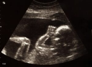Press på gravida att göra abort